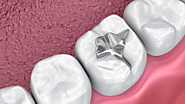 How to Choose the Right Type of Dental Fillings for You?