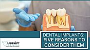 5 Unforgettable Reasons to Say Yes to Dental Implants
