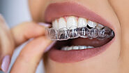 Unraveling the Timeline: The Clear Aligners Journey