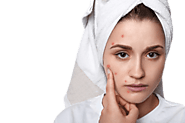 Acne-Prone Skin: Reasons and Remedies - Glamazle