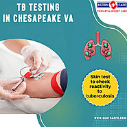 Get Accurate TB Testing Near Me in Chesapeake VA at Acorn Care