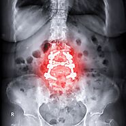 What Was the Most Popular MIS Spinal Implant Procedure in the US in 2023?