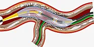 The Dynamic Landscape of the Intravascular Lithotripsy (IVL) Market - iData Research