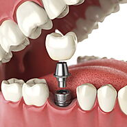 Top 3 Market Share Leaders in the Global Dental Implant Market