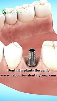 Dental Implants in Roseville, CA – Exceptional Care Guaranteed