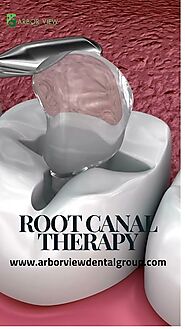 Root Canal Therapy: Everything You Need to Know in 25 Seconds!