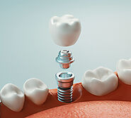 Dental Implants in Roseville, CA | Arbor View Dental Group