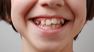 How Cosmetic Dentists Fix Crooked or Uneven Teeth