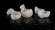 Types of Dental Crown Material