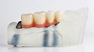 What are the Key Benefits of Dental Bridges?