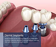 dental Implants