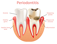 Best Periodontist in madinaguda | chanda nagar - capitaldentalcare