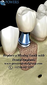 Replace a Missing Tooth with Dental Implants