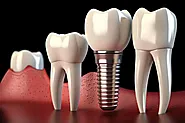 Discover Why Dental Implants Are Your Best Choice