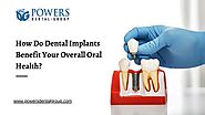 How Do Dental Implants Benefit Your Overall Oral Health