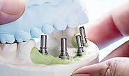 How Many Dental Implants Can Be Placed at One Time?