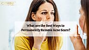 What are the Best Ways to Permanently Remove Acne Scars?