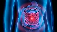 How Does the Microbiome Impact Irritable Bowel Syndrome?