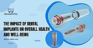 The Impact of Dental Implants on Overall Health and Well-being