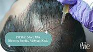 PRP Hair Before After | Efficiency, Benefits, Safety, and Cost.