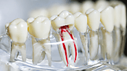 What to Expect During Your Root Canal Treatment