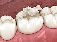 5 Reasons You Need a Ceramic Crown