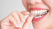 7 Signs You Are Ready for Invisalign