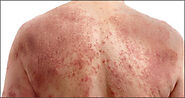 Ayurvedic Treatment Of Atopic Dermatitis With Herbal Remedies