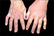 Ayurvedic Treatment Of Scleroderma (Systemic Sclerosis)