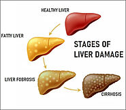 Why Fatty Liver Is on the Rise? Discover Ayurvedic Remedies from Planet Ayurveda