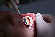 Cosmetic Crowns and Bridge Teeth in Pensacola, FL