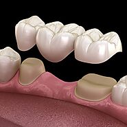 Removable Dental Bridge