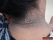DARK PATCHES (HYPERPIGMENTATION) WITH ACANTHOSIS NIGRICANS - Pharmaclinix