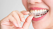 5 Things to Know Before Getting Invisalign