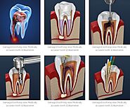 Root Canal Procedure