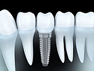 Dental Implants in Pensacola, FL: A Comprehensive Guide