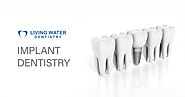 Dental Implants In Surrey, BC | Zygomatic Implant Treatment