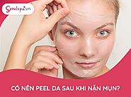 Có nên peel da sau khi nặn mụn?