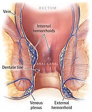 Best Hemorrhoids Doctor in NYC | Hemorrhoid Treatment Specialist in New York