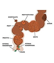 Rectal Bleeding Treatment Specialists in Downtown/Financial District