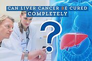 Can Liver Cancer Be Cured Completely? | Understanding Treatment Options