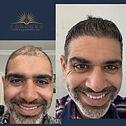 Concord Hair Restoration | Hair Restoration & Transplants