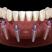 All on four dental implants