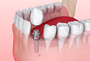 Full-mouth dental implants in Mexico are easy to maintain