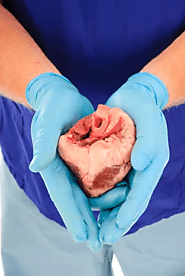 Heart Transplant Cost in India | Top Hospitals & Criteria | HOSPIDIO