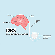 Deep Brain Stimulation cost in India starts from $20000 | DBS Surgery cost | HOSPIDIO