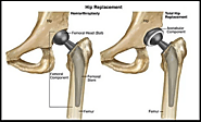 Hip Replacement Surgery Cost in India From $4500 | Robotic Surgery Available | HOSPIDIO