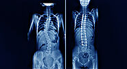 Affordable Spinal Scoliosis Surgery Cost in India with Hospidio