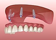 Dental Implant Treatment | Dental Implant Surgeon/ Doctor Annapurna Indore