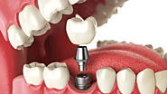 Dental Implants vs. Dental Bridges: Which Is the Better Option?